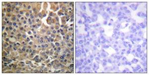 Immunohistochemical analysis of paraffin-embedded human breast carcinoma using Anti-HER4 (phospho Tyr1284) Antibody. The right hand panel represents a negative control, where the antibody was pre-incubated with the immunising peptide