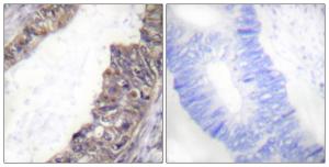 Immunohistochemical analysis of paraffin-embedded human colon carcinoma using Anti-GIRK1 (phospho Ser185) Antibody. The right hand panel represents a negative control, where the antibody was pre-incubated with the immunising peptide.