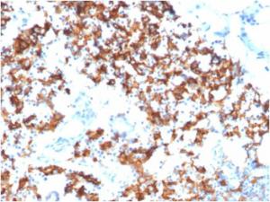 Immunohistochemical analysis of formalin-fixed, paraffin-embedded human gastric carcinoma using Anti-IL3RA Antibody [IL3RA/1531]