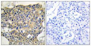 Immunohistochemical analysis of paraffin-embedded human breast carcinoma using Anti-EGFR (phospho Tyr1016) Antibody. The right hand panel represents a negative control, where the antibody was pre-incubated with the immunising peptide