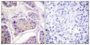 Immunohistochemical analysis of paraffin-embedded human breast cancer using Anti-EGFR (phospho Tyr1016) Antibody 1:100 (4 °C overnight). The right hand panel represents a negative control, where the antibody was pre-incubated with the immunising peptide