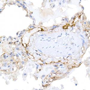 Immunohistochemistry analysis of paraffin-embedded human lung using Anti-Podoplanin / gp36 Antibody (A305444) at a dilution of 1:20 (40x lens). Perform high pressure antigen retrieval with 10 mM citrate buffer pH 6.0 before commencing with IHC staining protocol.