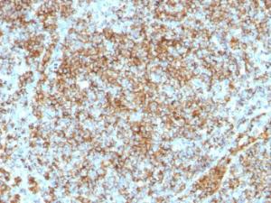 Immunohistochemical analysis of formalin-fixed, paraffin-embedded human lymphoma using Anti-CD45RB Antibody [SPM569]