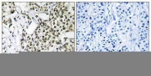 Immunohistochemical analysis of paraffin-embedded human breast carcinoma tissue using Anti-CAGE1 Antibody. The right hand panel represents a negative control, where the antibody was pre-incubated with the immunising peptide.