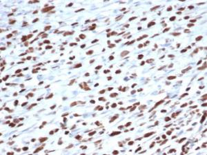 Immunohistochemical analysis of formalin-fixed, paraffin-embedded human rhabdomyosarcoma tissue using Anti-MyoD1 Antibody [5.8A]