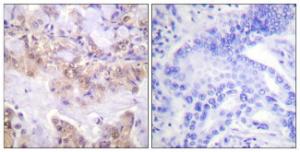 Immunohistochemical analysis of paraffin-embedded human lung carcinoma using Anti-C-RAF (phospho Ser621) Antibody. The right hand panel represents a negative control, where the Antibody was pre-incubated with the immunising peptide