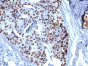 Immunohistochemical analysis of formalin-fixed, paraffin-embedded human lobular breast carcinoma tissue using Anti-GATA3 Antibody [GATA3/6664]