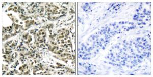 Immunohistochemical analysis of paraffin-embedded human breast carcinoma tissue using Anti-BRCA1 Antibody. The right hand panel represents a negative control, where the antibody was pre-incubated with the immunising peptide