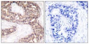 Immunohistochemical analysis of paraffin-embedded human breast carcinoma tissue using Anti-G3BP-1 Antibody. The right hand panel represents a negative control, where the antibody was pre-incubated with the immunising peptide