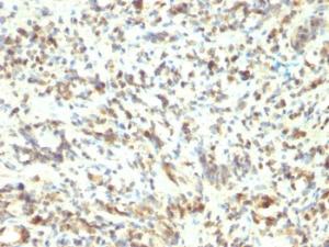 Immunohistochemical analysis of formalin-fixed, paraffin-embedded human rhabdomyosarcoma tissue using Anti-MyoD1 Antibody [5.8A]