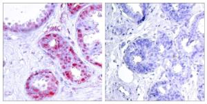 Immunohistochemical analysis of paraffin-embedded human breast carcinoma using Anti-c-Jun (phospho Ser243) Antibody. The right hand panel represents a negative control, where the Antibody was pre-incubated with the immunising peptide