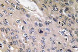 Immunohistochemical analysis of paraffin-embedded human lung carcinoma tissue using Anti-BMP-6 Antibody