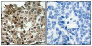 Immunohistochemical analysis of paraffin-embedded human breast carcinoma tissue using Anti-FKHRL1 Antibody. The right hand panel represents a negative control, where the antibody was pre-incubated with the immunising peptide