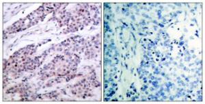 Immunohistochemical analysis of paraffin-embedded human breast carcinoma tissue using Anti-BCL-2 Antibody. The right hand panel represents a negative control, where the antibody was pre-incubated with the immunising peptide