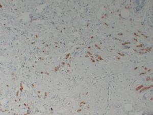 Immunohistochemical analysis of paraffin-embedded human Breast carcinoma using Anti-Mammaglobin Antibody