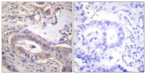 Immunohistochemical analysis of paraffin-embedded human lung carcinoma using Anti-BCL-XL (phospho Thr47) Antibody. The right hand panel represents a negative control, where the antibody was pre-incubated with the immunising peptide