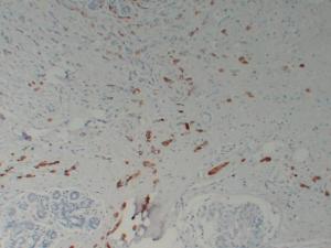 Immunohistochemical analysis of paraffin-embedded human Breast carcinoma using Anti-Mammaglobin Antibody