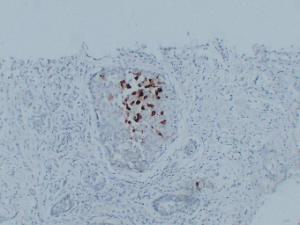 Immunohistochemical analysis of paraffin-embedded human Breast carcinoma using Anti-Mammaglobin Antibody