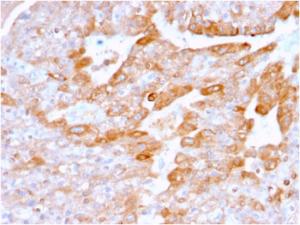 Immunohistochemical analysis of formalin-fixed, paraffin-embedded human renal cell carcinoma using Anti-CD137 Antibody [4-1BB/3201]