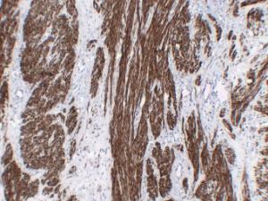 Immunohistochemical analysis of paraffin-embedded human Fibroid using Anti-Calponin 1 Antibody