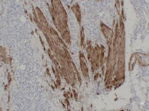 Immunohistochemical analysis of paraffin-embedded human Laryngeal squamous cell carcinoma using Anti-Calponin 1 Antibody