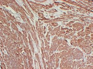 Immunohistochemical analysis of paraffin-embedded human Leiomyoma using Anti-Calponin 1 Antibody