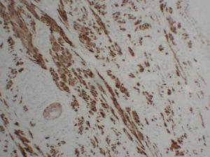 Immunohistochemical analysis of paraffin-embedded human Squamous carcinoma of the cervix using Anti-Calponin 1 Antibody