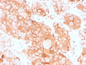 Immunohistochemical analysis of formalin-fixed, paraffin-embedded human testicular carcinoma using Anti-Prolactin Receptor Antibody [PRLR/3785R]