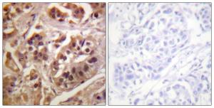 Immunohistochemical analysis of paraffin-embedded human lung carcinoma tissue using Anti-IKK-gamma Antibody. The right hand panel represents a negative control, where the antibody was pre-incubated with the immunising peptide.