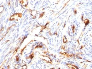 Immunohistochemical analysis of formalin-fixed, paraffin-embedded human endometrial carcinoma using Anti-beta 2 Microglobulin Antibody [B2M/1118]