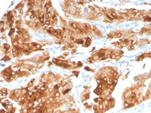 Immunohistochemical analysis of formalin-fixed, paraffin-embedded human urothelial carcinoma using Anti-Uroplakin 1A Antibody [UPK1A/2922]