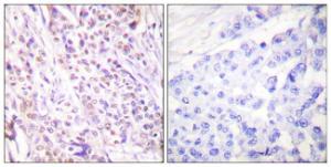 Immunohistochemical analysis of paraffin-embedded human breast carcinoma tissue using Anti-RAD17 Antibody. The right hand panel represents a negative control, where the antibody was pre-incubated with the immunising peptide.