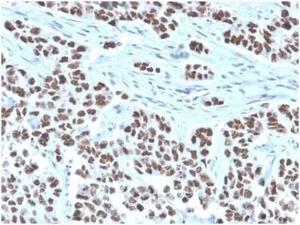 Immunohistochemical analysis of formalin-fixed, paraffin-embedded human lung tissue using Anti-NFIA Antibody [PCRP-NFIA-2C6]