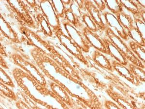 Immunohistochemical analysis of formalin-fixed, paraffin-embedded human renal cell carcinoma using Anti-Calnexin Antibody [CANX/1541]