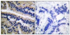 Immunohistochemical analysis of paraffin-embedded human lung carcinoma tissue using Anti-Caspase 9 (cleaved Asp353) Antibody. The right hand panel represents a negative control, where the antibody was pre-incubated with the immunising peptide.