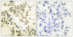 Immunohistochemical analysis of paraffin-embedded human breast carcinoma tissue using Anti-DNA-PK Antibody. The right hand panel represents a negative control, where the Antibody was pre-incubated with the immunising peptide