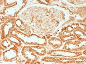 Immunohistochemical analysis of formalin-fixed, paraffin-embedded human renal cell carcinoma using Anti-Calnexin Antibody [CANX/1541]