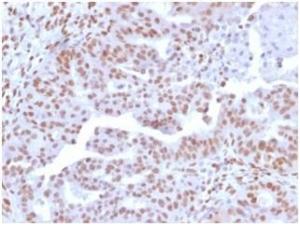 Immunohistochemical analysis of formalin-fixed, paraffin-embedded human colon carcinoma tissue using Anti-NFIA Antibody [PCRP-NFIA-2C6]