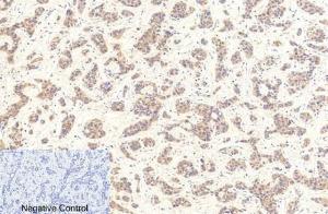 Immunohistochemical analysis of paraffin-embedded human liver cancer tissue using Anti-Caspase 9 (cleaved Asp353) Antibody at 1:200 (4°C overnight). Negative control was secondary antibody only.