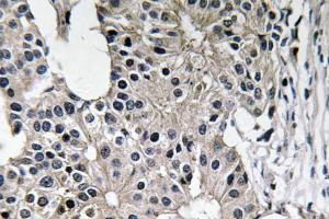 Immunohistochemical analysis of paraffin-embedded human breast carcinoma tissue using Anti-Caspase-7 Antibody