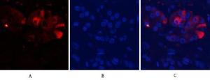 Immunofluorescence analysis of human stomach cancer tissue using Anti-Caspase 9 (cleaved Asp353) Antibody (red) at 1:200 (4°C overnight). Cy3 labelled secondary antibody was used at 1:300 (RT 50min). Panel A: Target. Panel B: DAPI. Panel C: Merge.