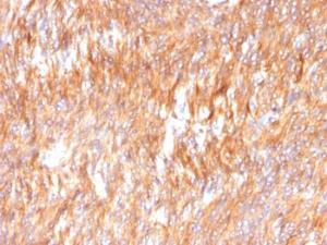 Immunohistochemical analysis of formalin-fixed, paraffin-embedded human small intestinal carcinoma using Anti-Calnexin Antibody [CANX/1541]