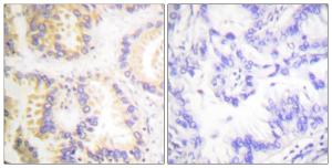 Immunohistochemical analysis of paraffin-embedded human lung carcinoma using Anti-Caspase 8 (phospho Ser347) Antibody. The right hand panel represents a negative control, where the antibody was pre-incubated with the immunising peptide.