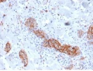 Immunohistochemical analysis of formalin-fixed, paraffin-embedded human melanoma tissue using Anti-p75 NGF Receptor Antibody [NGFR/4919] at 2µg/ml