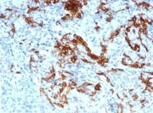 Immunohistochemical analysis of formalin-fixed, paraffin-embedded human melanoma tissue using Anti-p75 NGF Receptor Antibody [NGFR/4919] at 2µg/ml. Inset: PBS instead of the primary antibody. Secondary antibody negative control.