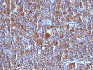 Immunohistochemical analysis of formalin-fixed, paraffin-embedded Hodgkin's lymphoma using Anti-Bax Antibody [BAX/962]