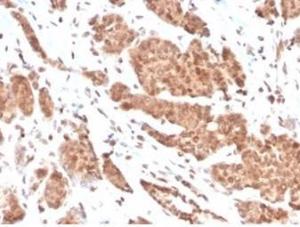 Immunohistochemical analysis of formalin-fixed, paraffin-embedded human breast carcinoma tissue using Anti-NME1 Antibody [NME1/2737]