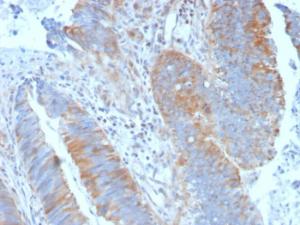 Immunohistochemical analysis of formalin-fixed, paraffin-embedded human colon carcinoma using Anti-Calpain 1 Antibody [CAPN1/1530]