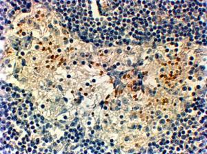 Anti-FOXC2 Antibody (A83941) (2 µg/ml) staining of paraffin embedded Human Breast cancer. Steamed antigen retrieval with Tris/EDTA buffer pH 9, HRP-staining