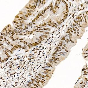 Immunohistochemistry analysis of paraffin-embedded human colon carcinoma tissue using Anti-Metnase Antibody (A9984) at a dilution of 1:100 (40X lens). Perform high pressure antigen retrieval with 10 mM citrate buffer pH 6.0 before commencing with IHC staining protocol